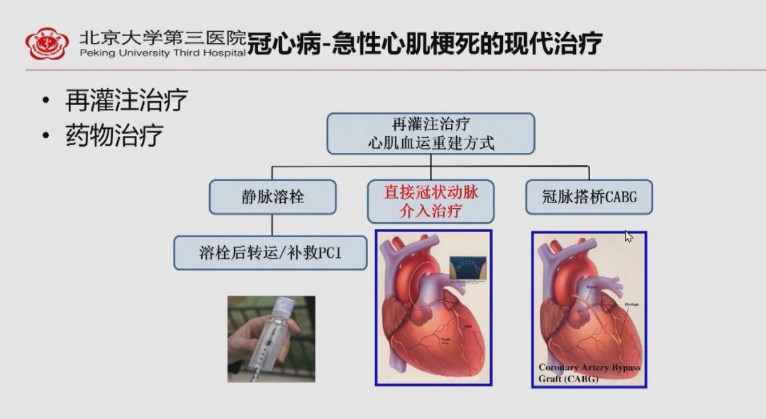 心肌梗死最新治疗进展,心肌梗死最新治疗进展